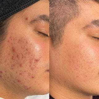 Before & After Acne