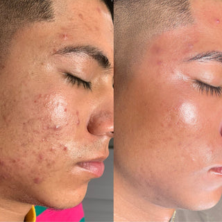 Acne Bootcamp in El Paso, TX