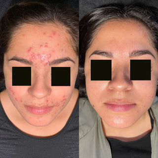 Acne Results