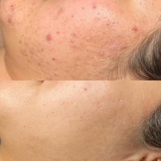 Acne Treatment Results