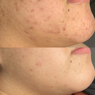 Acne Treatments Before & After