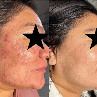 Face Reality Acne Bootcamp