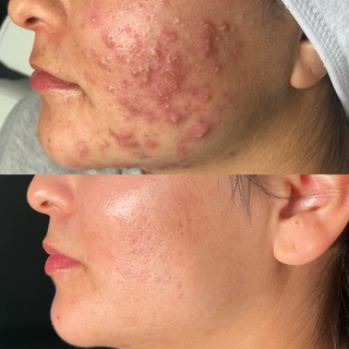 Glowing Skin after Acne Treatment