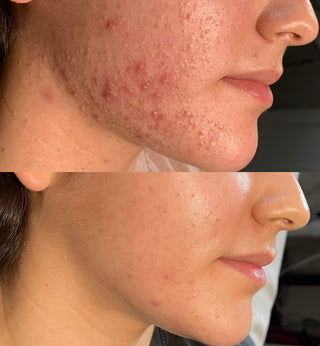 Before & After Acne Treatment