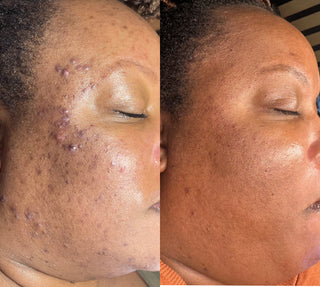 Clear Skin Journey